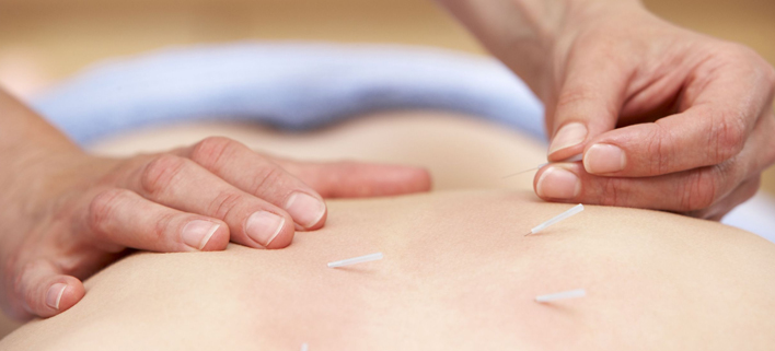 Are you suffering from lower back, frozen shoulders and even sciatica? Proven for thousands of years acupuncture can quickly relieve these pains. 